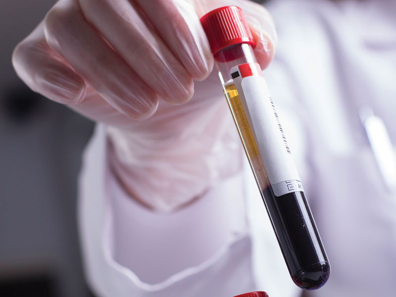 What Is a Liquid Biopsy?