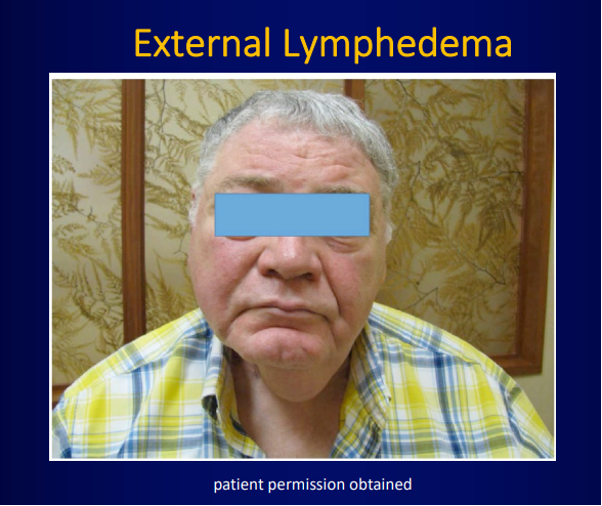 Images from Lymphedema and Fibrosis in Head and Neck Cancer Survivors: Manifestations and Assessment by Jie Deng, PhD, RN, OCN®, FAAN. Used with permission.