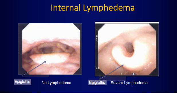 Images from Lymphedema and Fibrosis in Head and Neck Cancer Survivors: Manifestations and Assessment by Jie Deng, PhD, RN, OCN®, FAAN. Used with permission.