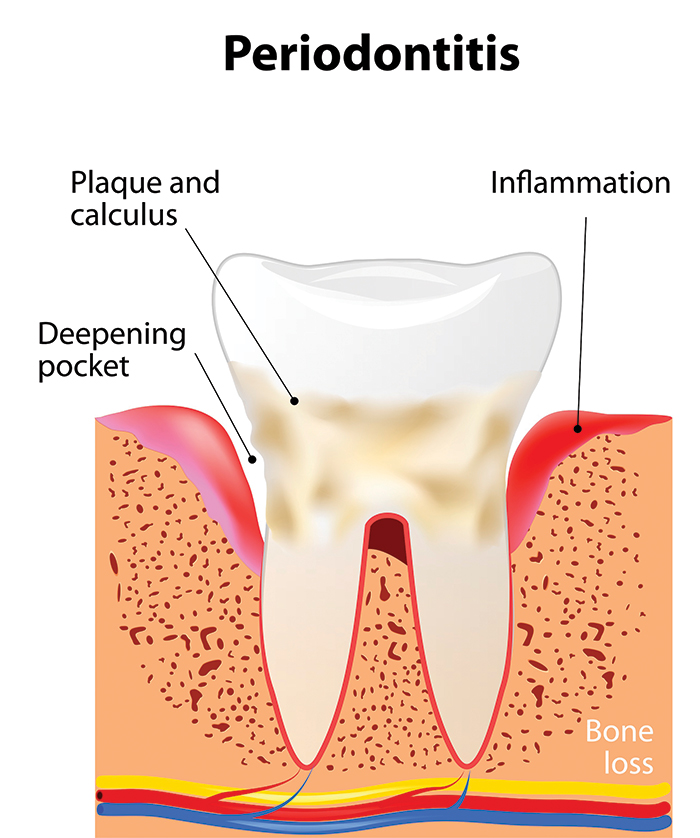 periodontis